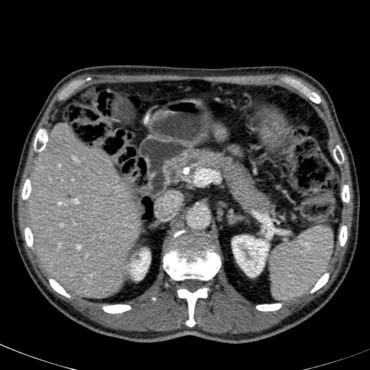 Diagnosis: Non-resectable Klatskin tumor Bismuth type 4 R/ Chemotherapy