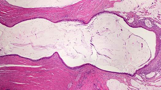 dysplasia in all but one Well differentiated tubular, circular or ameboid glands Single layer of