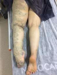 Capillary malformations This is the most common cutaneous manifestation of KTS.