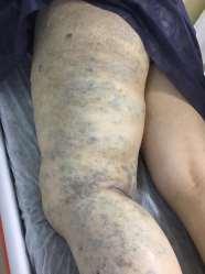 Varicose veins-venous Can occur in both the superficial and deep venous