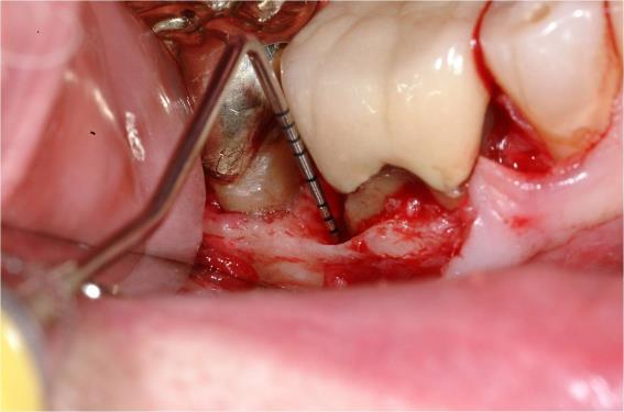 regrow the bone and gum attachment to the tooth Bone regeneration TREATMENTS FOR PERIODONTAL DEFECTS Gingivectomy Not often performed; mostly cosmetic Pocket formation without bone loss Remove