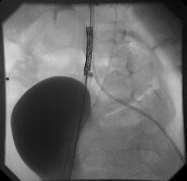 TRANSCATHETER REPLACEMENT OF THE PULMONARY VALVE GREEK EXPERIENCE Results PGr: 0