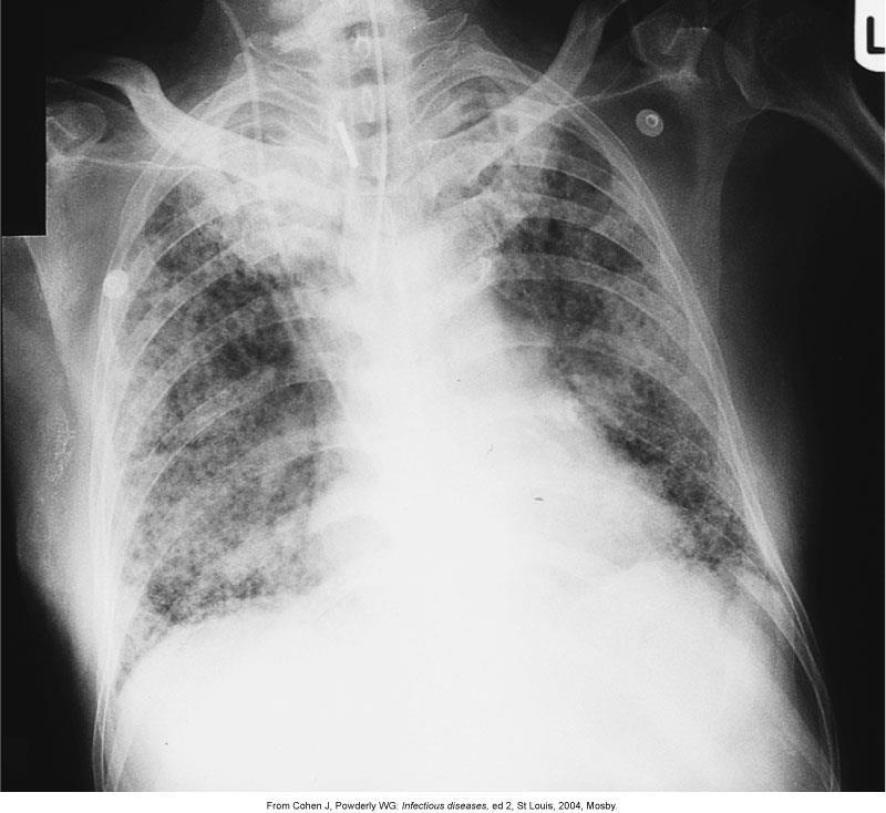 CHEST X-RAY FINDINGS : WHITEOUT OR WHITE LUNG R/T CONSOLIDATION