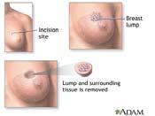 BREAST CONSERVING SURGERY (versus mastectomy) SENTINEL LYMPH NODE BIOPSY NODAL IRRIDATION (versus complete nodal