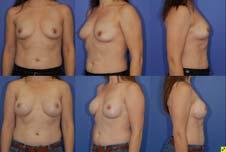 NIPPLE SPARING MASTECTOMY AND CONTRALATERAL PROPHLACTIC MASTECTOMY Breast Cancer Surgery Future Directions - Observation COMET trial - Non operative ablation Radiofrequency, cryoablation -