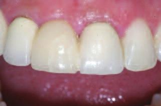 occlusal trauma Reduced number of teeth Shortened dental arch Lack of posterior teeth