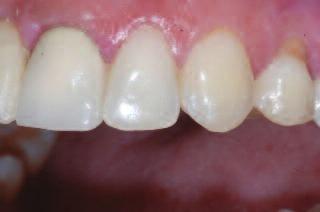 Anterior tooth position OB increased / reduced Retroclined incisors Distalised mandible Tooth