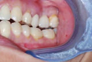In order to show how occlusion can and should incorporated into a restorative treatment plan