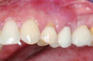 If the trauma was removed from the tooth and no further bone loss occurred the tooth would have a good prognosis.