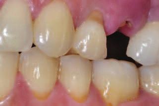 The UR6 had a narrow area of interproximal bone and significant buccal recession.