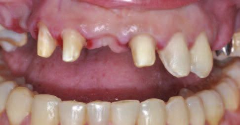 The UL4 and UL5 were deemed hopeless due to the bone loss and mobility around the UL4 and the fracture, caries and heavily restored nature of UL5.