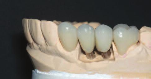 Figure 23: Fully restored and rehabilitated dentition.