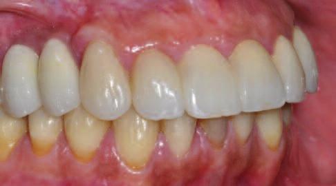 Occlusal considerations in periodontics.
