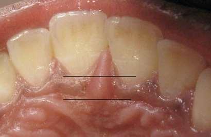 Lecture Prosthodontic Dr. Osama Arrangement of the artificial teeth: It s the placement of the teeth on a denture with definite objective in mind or it s the setting of teeth on temporary bases.