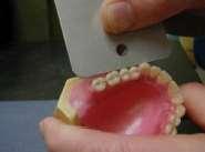 Use a template to check the buccal alignment of canine, premolars and mesial