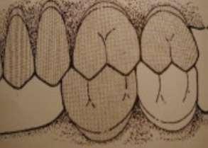 1. Arrangement of maxillary posterior teeth: - a. Maxillary premolars: 1. Premolars are set vertically to occlusal plane (a plane passing through the occlusal surfaces of the teeth). 2.