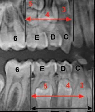 Secondary spacing : Term was coined by Baume Observed in closed primary dentition Secondary spacing can also occur during the eruption of permanent central incisors they push the primary canine