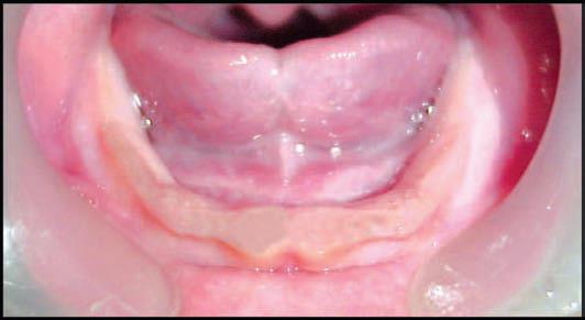 upper gum pad being more wider and longer than lower gum pads thus when approximated a complete over jet present all
