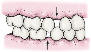 Two types of primary dentitions seen A- Closed primary dentition: absence of spaces is an indication that crowding of teeth may occur when the larger permanent teeth erupt.