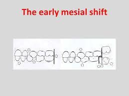 . Late mesial Shift: This occurs in the late mixed dentition period when the second deciduous molar exfoliate the first permanent molar drift mesialy & use leeway space and is thus called late shift.