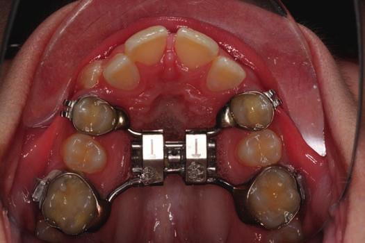 80 Illustrated Questions in Orthodontics Question 7.9 A What is this appliance called?