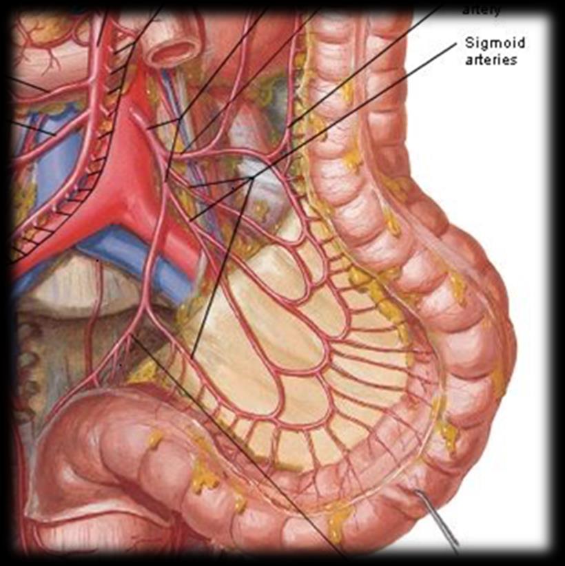Vascular approach Inferior Mesenteric Artery (IMA) approach Section of IMA High ligation Low ligation