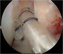 Discussions Post-operative knee stability with respect to surgical timing Author Journal Early Delayed Graft type follow-up Results Barenius et al. 4) Raviraj et al. 9) Sgaglione et al. 10) Ahn et al.