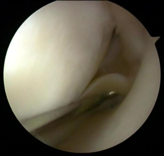 Materials and Methods 149 ACL-injured patients Systematic arthroscopic