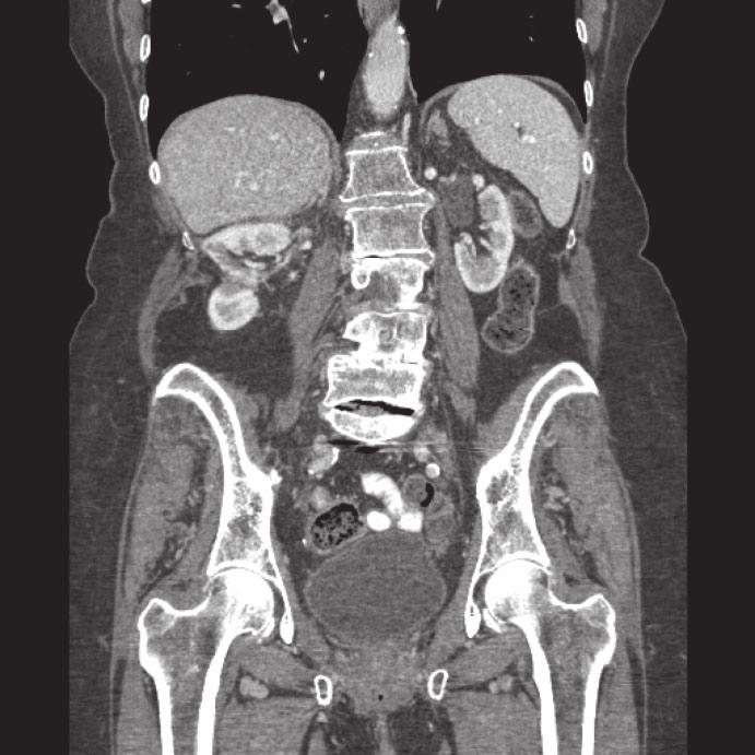 Karam et al. Fig. 1 CT scans of a patient with failed cryoablation carried out elsewhere, who presented with an estimated GFR of 42 ml/min/1.