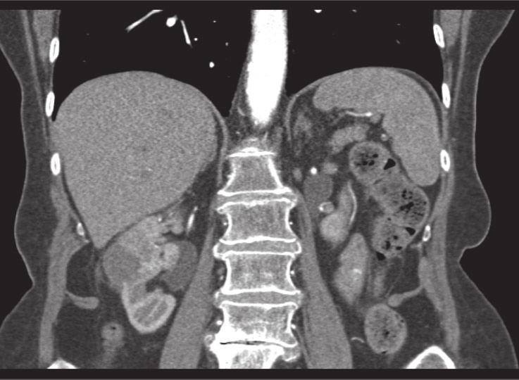(B) Preoperative coronal view of the right renal mass and renal vein thrombus (white arrow). (C) Preoperative axial view of the right renal mass and renal vein thrombus (white arrow).