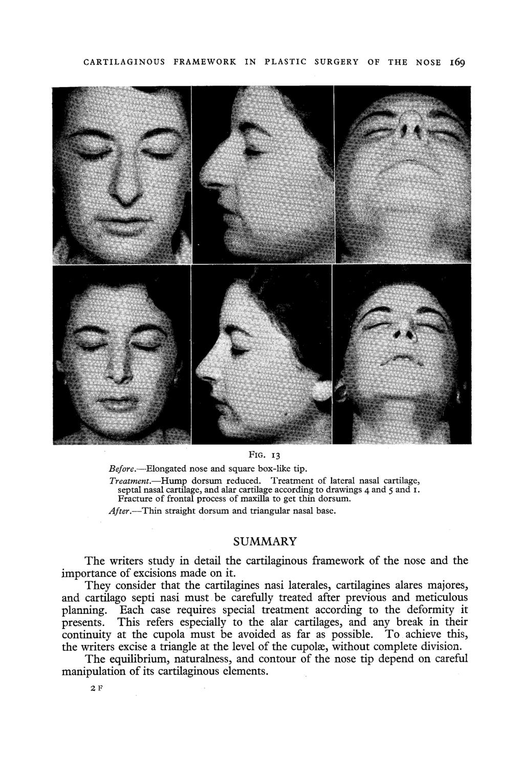 CARTILAGINOUS FRAMEWORK IN PLASTIC SURGERY OF THE NOSE 169 FIG. 13 Before.--Elongated nose and square box-like tip. Treatmem.--Hump dorsum reduced.