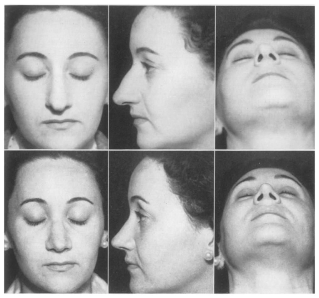 CARTILAGINOUS FRAMEWORK IN PLASTIC SURGERY OF THE NOSE 16 3 FIG. 7 Before.--Long nose and hump nose. Asymmetry of nostrils. Square box-like tip. Treatment.
