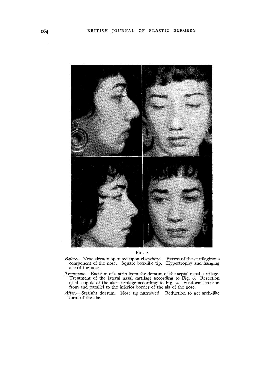 16 4 BRITISH JOURNAL OF PLASTIC SURGERY FIG. 8 Before.--Nose already operated upon elsewhere. Excess of the cartilaginous component of the nose.