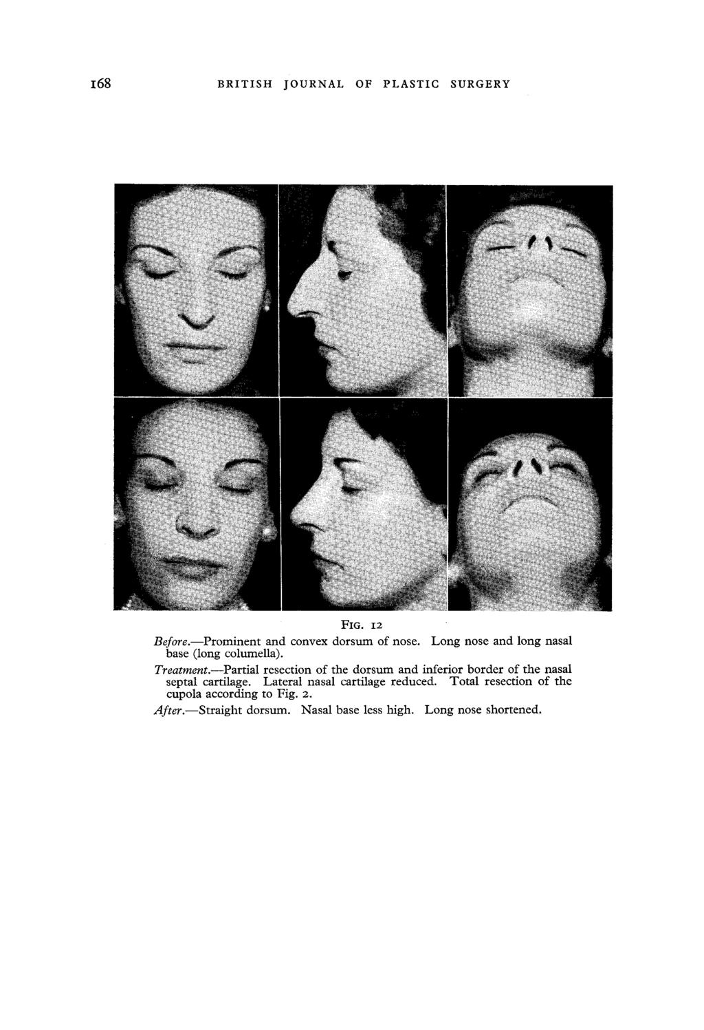 168 BRITISH JOURNAL OF PLASTIC SURGERY FIG. I2 Before.--Prominent and convex dorsum of nose.