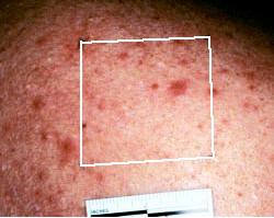 treatment in which lesion clearance is seen. Figure 3 shows a photograph of the control area on the same subject s back at the same time point in which several lesions are seen.