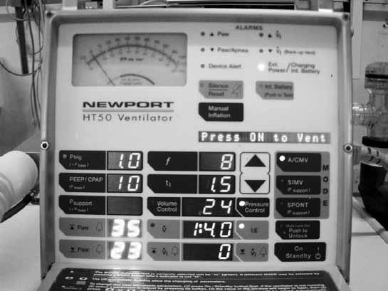 In some resource-poor settings, the ventilator used in ICU may offer only a mandatory mode.