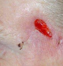 A smooth raised growth can appear with an ulcer in the centre.