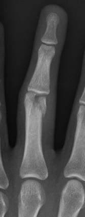 Phalanx Fractures Check for skin