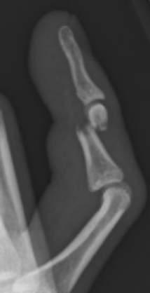 Phalangeal neck fractures (proximal/middle