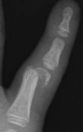 3 radiographic views Usually displaced These are