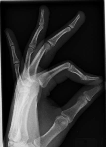 Radiographs performed 2 weeks into
