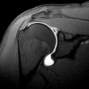Labral Pathology - Evaluation H&P as above Pain during acceleration Loss of