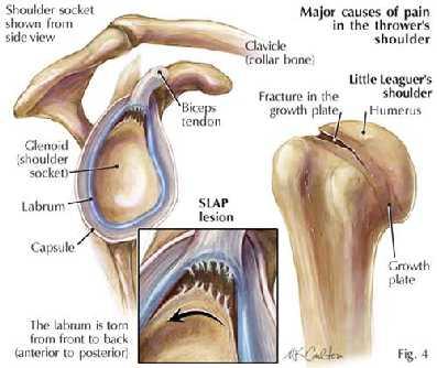 Shoulder Injuries Rotator cuff Instability