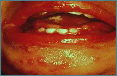 NON-GENITAL HSV-1(Gingivostomatitis): Recurrent herpes labialis (cold sore) is the most frequent clinical