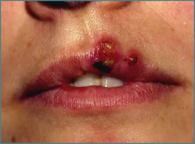 include a burning pain followed by small blister or sores GENITAL HSV-2: recurrent is less severe and without