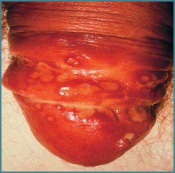 herpetic lesions. It was formerly seen in health-care workers and dentists, but is prevented by protective gloves.