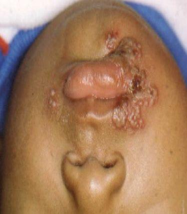 b. Treatment Can be made clinically when characteristic lesions are recognized.