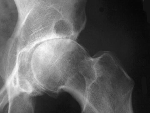 Factors associated with hip osteoarthritis: Increasing age Family history of osteoarthritis Previous injury to the