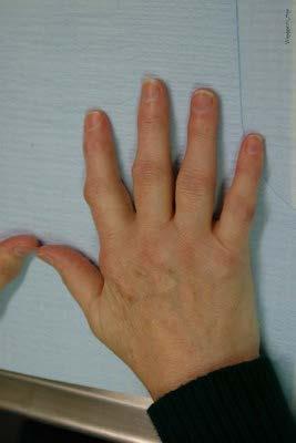 Osteoarthritis of the hands Distal interphalangeal (DIP) joints are most often affected Proximal