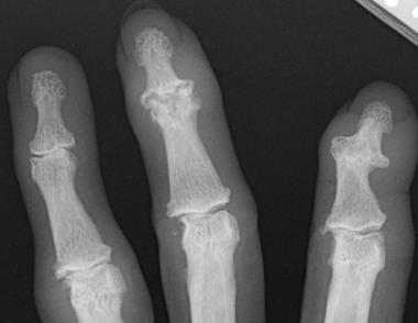 Inflammatory osteoarthritis Narrowing and osteophytes affecting multiple interphalangeal joints.